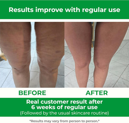 Anti-Cellulite Massage Roller