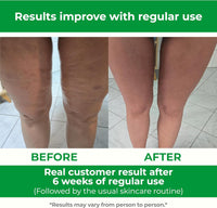 Anti-Cellulite Massage Roller